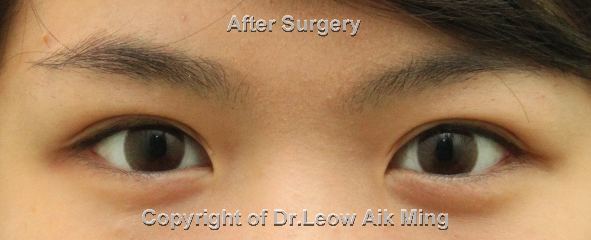 double eyelid surgery malaysia price