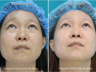 Laser Resurfacing