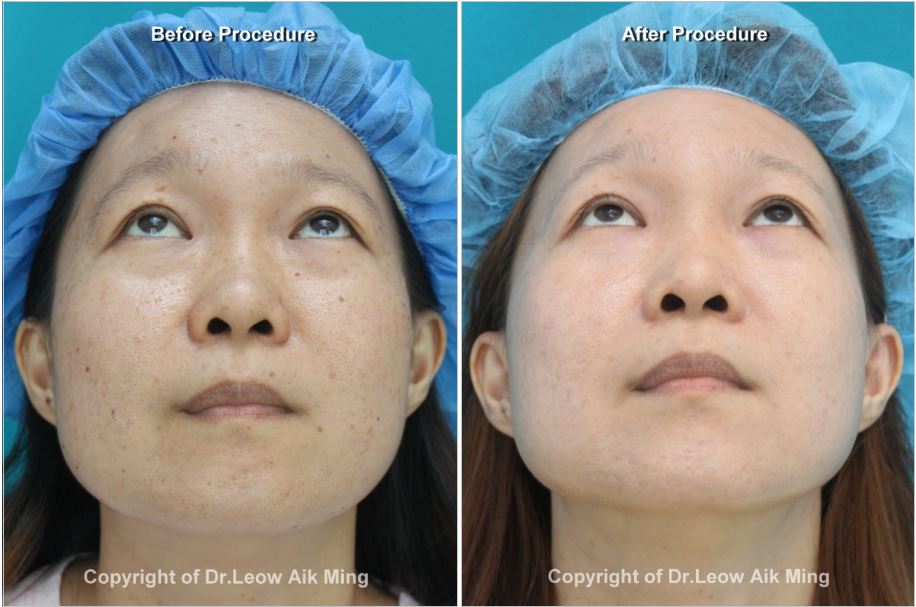 Laser Resurfacing