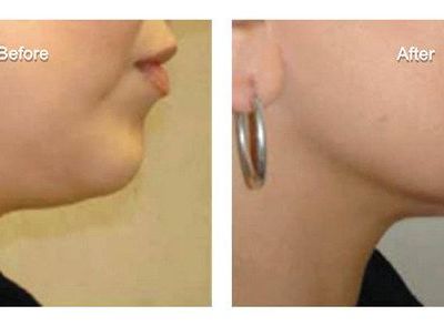 Injectable Fat Removal For Double Chin