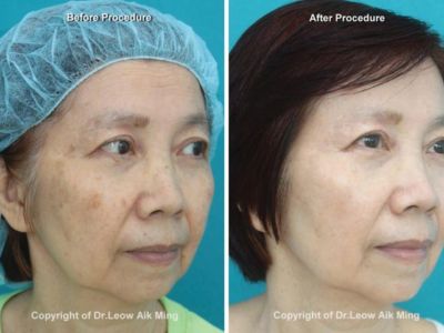 Laser Skin Resurfacing Ipoh