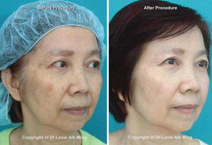 Laser Skin Resurfacing Ipoh