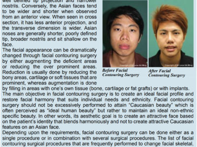 Facial Contouring (Facial-Sculpting) Surgery for Asians