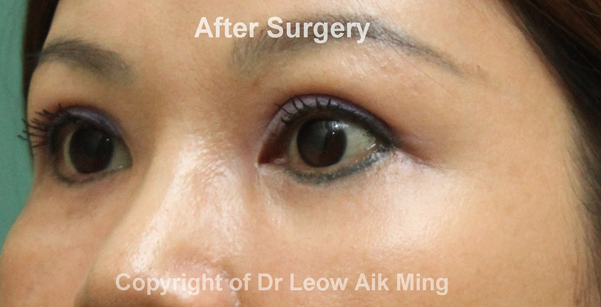 2.-After-Lateral-Canthoplasty