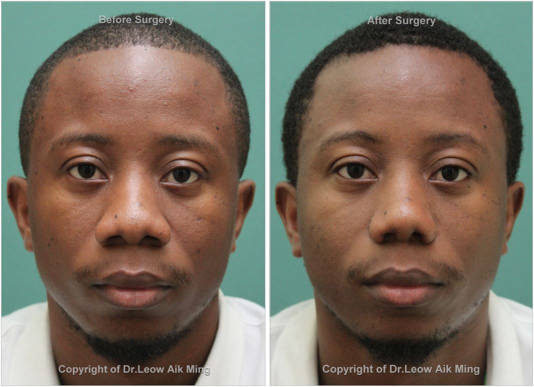 Before Alarplasty or Nostril Reduction Surgery 1