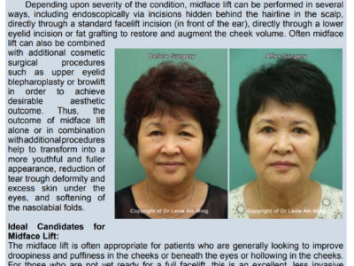 Midface-Lift-(Cheek-Lift)