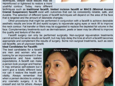 Facelift-(Rhytidectomy)