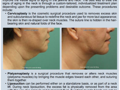 Neck Lift