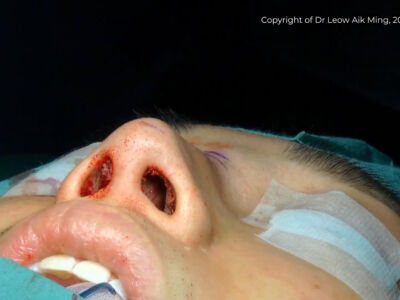 Rib Cartilage Graft For Revision Rhinoplasty